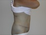 Abdominoplasty, postop lateral view