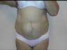 Abdominoplasty, preop frontal view