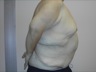 Abdominoplasty after WLS, postop lateral view