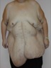 Abdominoplasty after WLS, preop frontal view