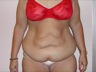 Abdominoplasty after WLS, preop frontal view