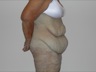 Abdominoplasty after WLS, preop lateral view