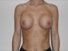 Breast Augmentation, postop frontal view