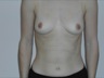 Breast Augmentation, preop frontal view