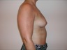 Breast Augmentation, preop lateral view