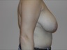 Breast Reduction, preop lateral view