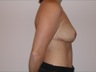 Breast Reduction, postop lateral view