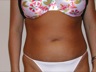Liposuction, preop frontal view