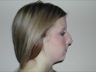 Rhinoplasty, preop lateral view