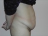 Abdominoplasty after WLS, preop lateral view