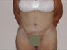 Abdominoplasty after WLS, postop frontal view