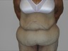 Abdominoplasty after WLS, preop frontal view