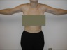 Arm Lift, postop frontal view