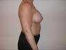 Breast Augmentation, postop lateral view