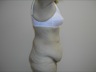 Belt Lipectomy, preop lateral view