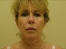 Facelift, preop frontal view