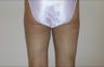 Liposuction, postop posterior view