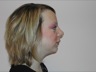 Rhinoplasty, postop lateral view